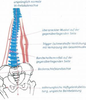 Beckenschiefstand